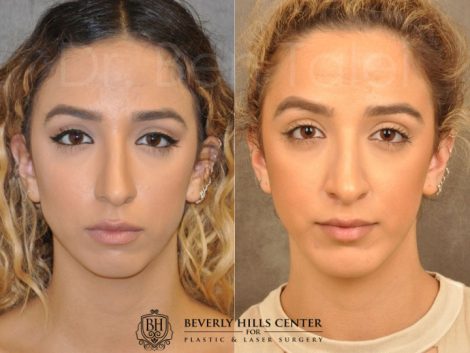 Beverly Hills Center Female Patient Before and After Chin Implant Procedure