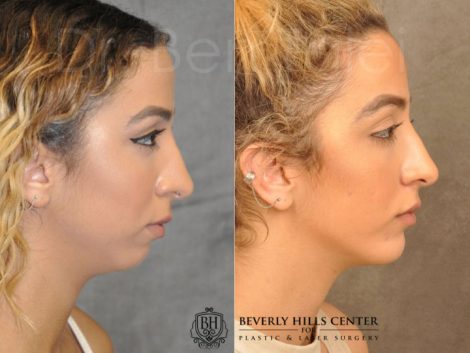 Beverly Hills Center Female Patient Before and After Chin Implant Procedure