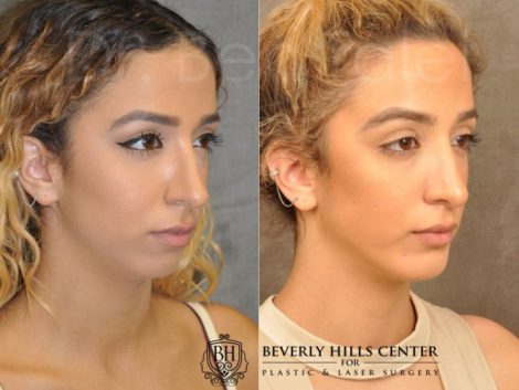 Beverly Hills Center Female Patient Before and After Chin Implant Procedure