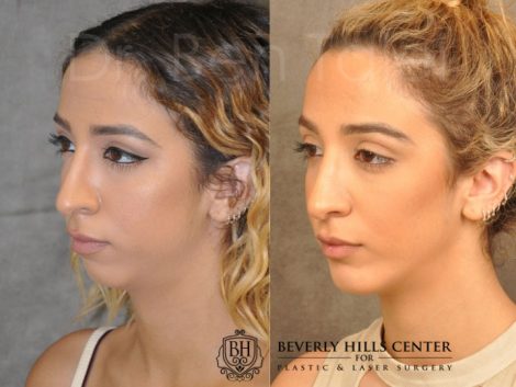 Beverly Hills Center Female Patient Before and After Chin Implant Procedure