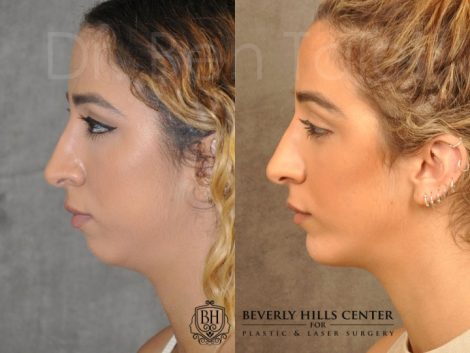 Beverly Hills Center Female Patient Before and After Chin Implant Procedure