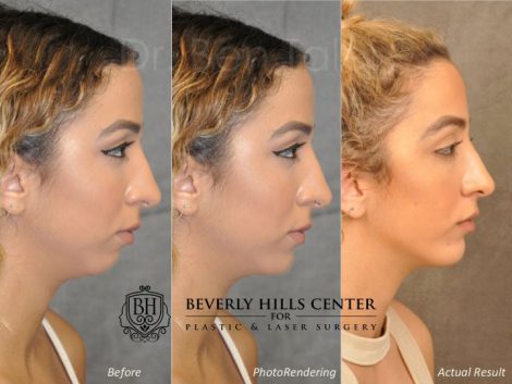 Beverly Hills Center Female Patient Before and After Chin Implant Procedure