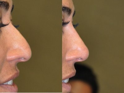 Non Surgical Rhinoplasty / Liquid Nosejob