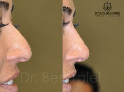 Beverly Hills Center Female Patient Before and After Non-surgical Rhinoplasty Procedure