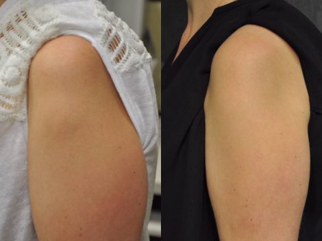 Beverly Hills Center Female Patient Before and After Kybella Injections Treatment