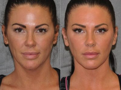 Cheek Enhancement & Neck MicroLiposuction - Front