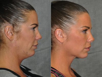 Cheek Enhancement & Neck MicroLiposuction - Right Side