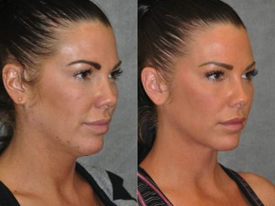Cheek Enhancement & Neck MicroLiposuction - Right Side