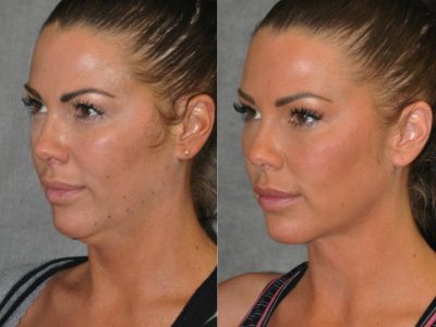 Cheek Enhancement & Neck MicroLiposuction - Left Side
