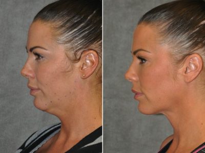Cheek Enhancement & Neck MicroLiposuction - Left Side
