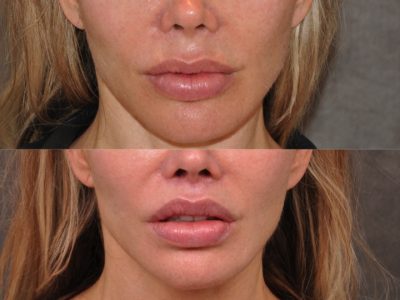 Modified Upper Lip Lift - Front