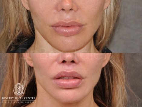 Modified Upper Lip Lift - Front