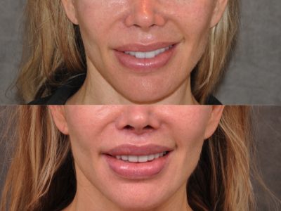 Modified Upper Lip Lift - Front