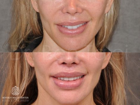 Modified Upper Lip Lift - Front