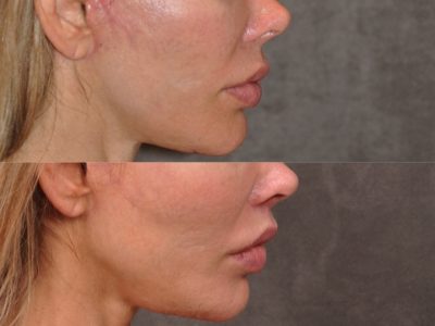 Modified Upper Lip Lift - Right Side