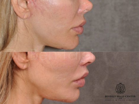 Modified Upper Lip Lift - Right Side