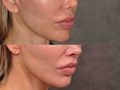 Modified Upper Lip Lift - Right Side