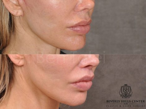 Modified Upper Lip Lift - Right Side