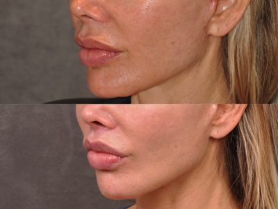 Modified Upper Lip Lift - Left Side