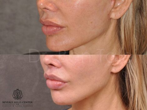 Modified Upper Lip Lift - Left Side