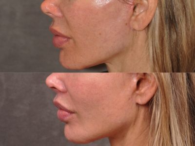 Modified Upper Lip Lift - Left Side