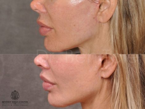 Modified Upper Lip Lift - Left Side