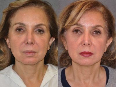 Profound Skin Tightening – Front