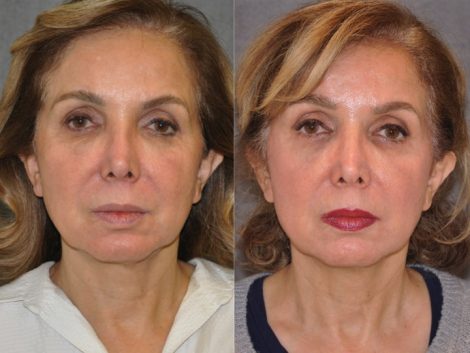 Profound Skin Tightening – Front