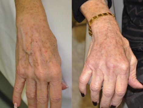 Beverly Hills Center Female Patient Before and After Hand Rejuvenation Procedure