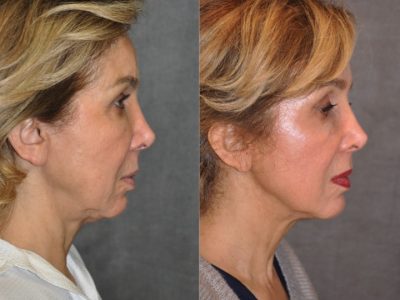 Profound Skin Tightening – Right Side