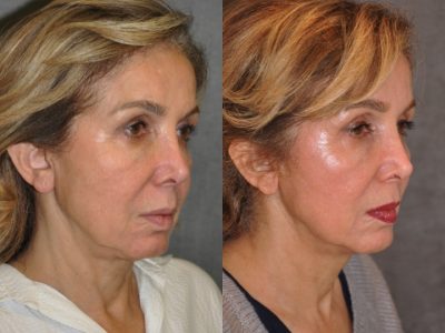 Profound Skin Tightening – Right Side