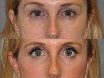 AuraLyft with Eye Rejuvenation - Front
