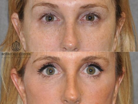 AuraLyft with Eye Rejuvenation - Front