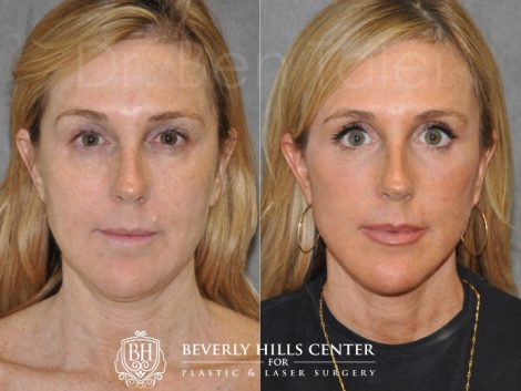 Beverly Hills Center Female Patient Before and After Lip Moles Excision