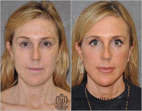 AuraLyft with Eye Rejuvenation - Front