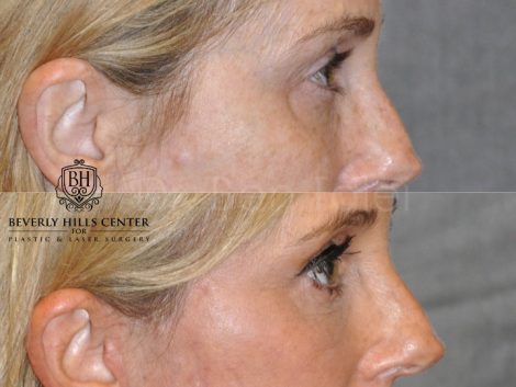 AuraLyft with Eye Rejuvenation - Right Side