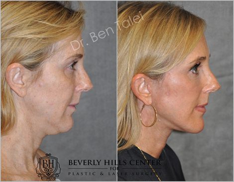 AuraLyft with Eye Rejuvenation - Right Side