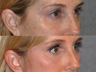 AuraLyft with Eye Rejuvenation - Right Side