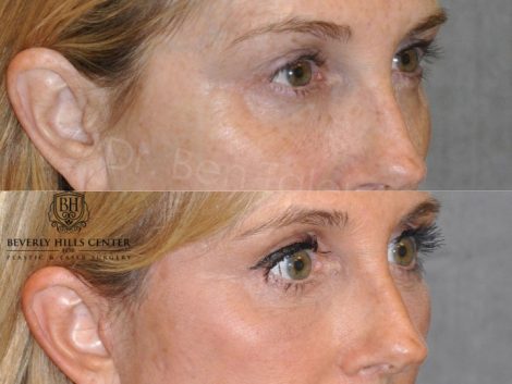 AuraLyft with Eye Rejuvenation - Right Side