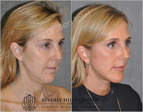 AuraLyft with Eye Rejuvenation - Right Side