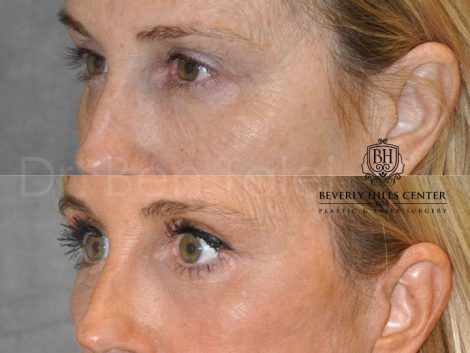 AuraLyft with Eye Rejuvenation - Left Side