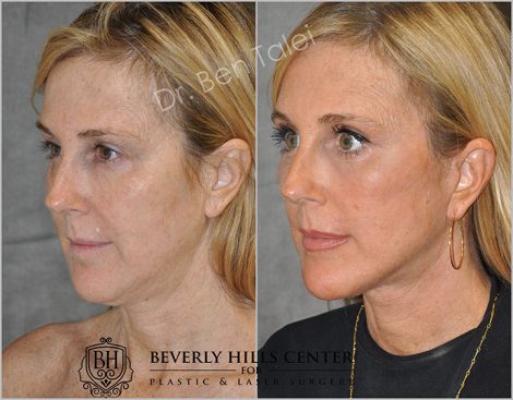 AuraLyft with Eye Rejuvenation - Left Side