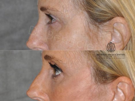 AuraLyft with Eye Rejuvenation - Left Side