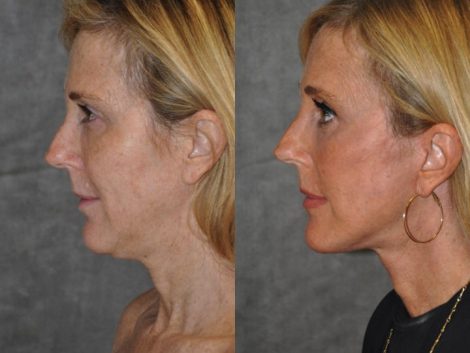 AuraLyft with Eye Rejuvenation - Left Side
