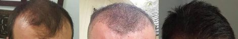Before, Immediately after FUE, and after at the 9 months post op mark