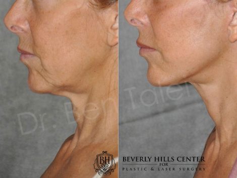 Awake Deep Plane Mini Facelift - Left Side