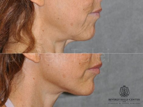 Lip Augmentation - Right Side