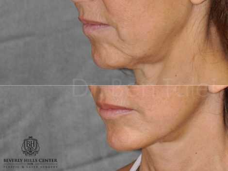 Lip Augmentation - Left Side