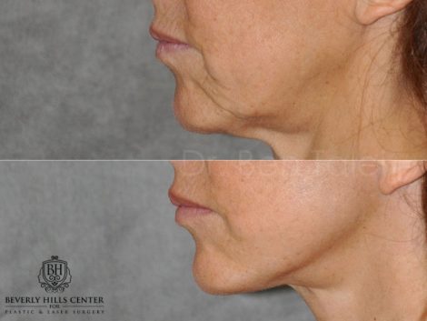 Lip Augmentation - Left Side