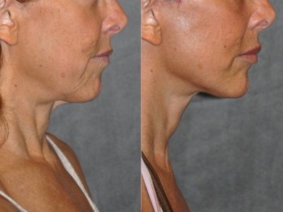 Awake Deep Plane Mini Facelift - Right Side